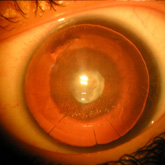 Cataract associated with aniridia