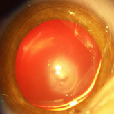 Mittendorf Cataract de Mittendorf (without persistent fetal vascularization)