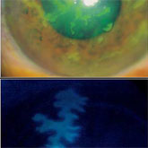 Fluorescein stained Herpetic keratitis. Courtesy Dr L Torro