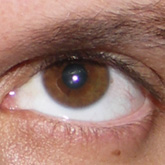 Hypertropia (left eye)