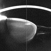 Crystalline lens luxation (Pentacam). Courtesy Dr L Torro