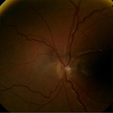Optic nerve hypoplasia