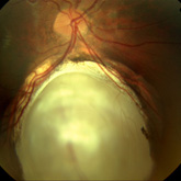 Coloboma of the retina and choroid