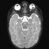 Retinoblastoma (MRI)
